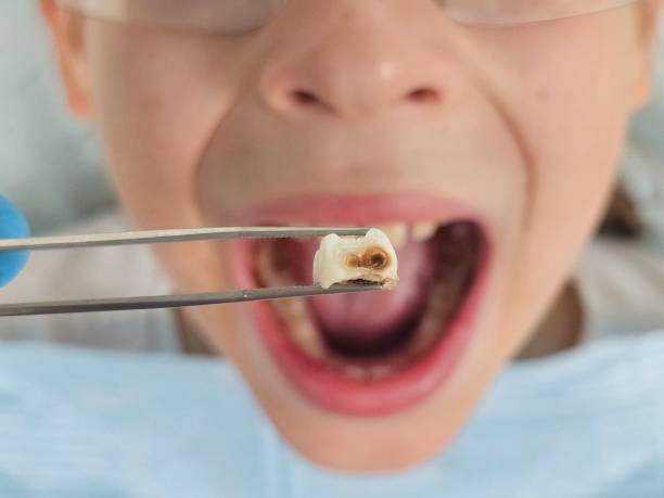 Best Cracked Tooth Emergency Dentist  in Cedar Creek, TX
