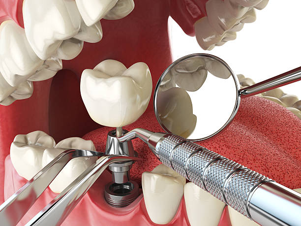 Best Urgent Tooth Repair  in Cedar Creek, TX